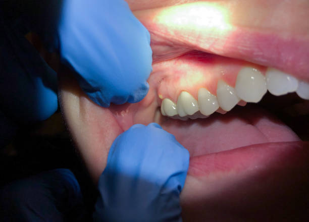 Best Emergency Treatment for Dental Infections or Abscesses in Fredonia, KS