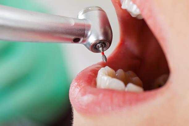 Best Emergency Wisdom Teeth Removal in Fredonia, KS